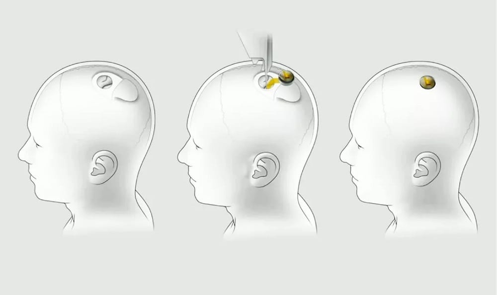 Neuralink（ニューラリンク）