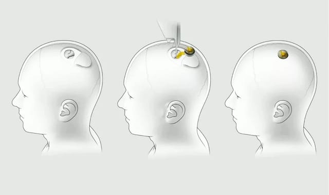 究極のハンズフリーを実現させるICチップ